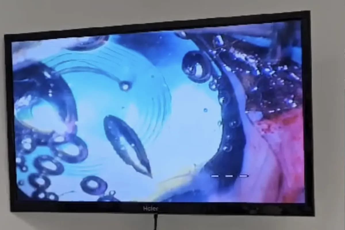 Chirurgie de la cataracte